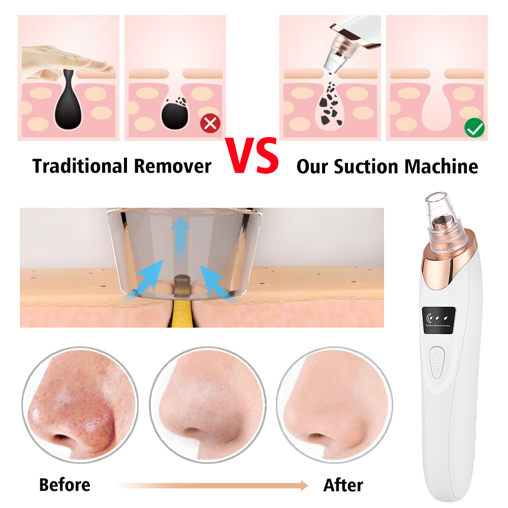 Blackhead Remover Vacuum Pore  - Nasal Aspirator review and price